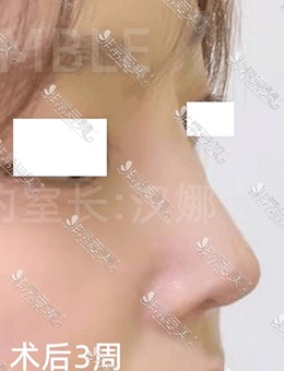 韩国德丽珍医院初鼻手术术前术后三周对比变化！