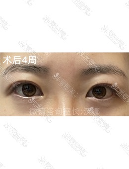 韩国德丽珍整形外科双眼皮手术，她说打开了新世界_术后
