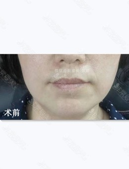 韩国德丽珍整容外科面部拉皮3个月后的样子图片分享~_术前