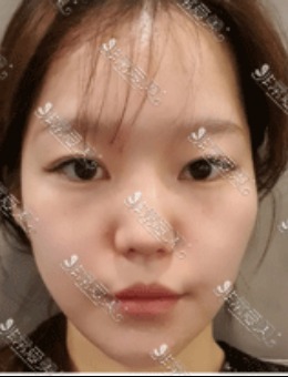 韩国宝士丽做面部脂肪移植，不愧是整友们推荐的医院！_术前