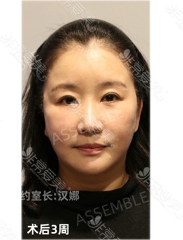 在韩国德丽珍整形医院做中面部拉皮手术之后年轻好几岁！