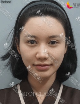 小翘鼻术后不会网红脸，不信你看韩国topclass的日记图！