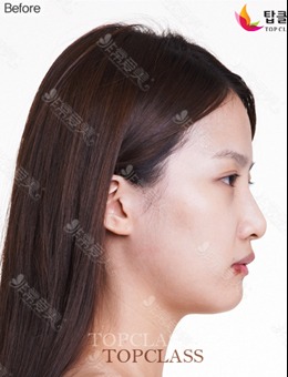 鼻子整形图片对比女分享，源自韩国topclass整形医院官网_术前