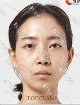 韩国Topclass医院眼鼻整形手术前后对比照分享，变化明显！_术前