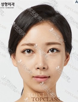-韩国Topclass医院眼鼻整形手术前后对比照分享，变化明显！