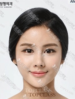 -在韩国Topclass整形外科做了眼鼻整形手术，气质提升了很多！