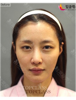 韩国topclass整形外科做鼻子和脂肪填充案例对比照分享!_术前