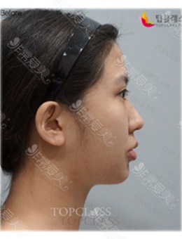 在韩国topclass整形外科做鼻子之后下巴后缩都改善了!_术前