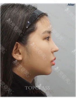 在韩国topclass整形外科做鼻子之后下巴后缩都改善了!_术后