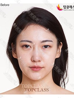 -韩国Topclass整形外科做了眼鼻整形，术后风格大变样！