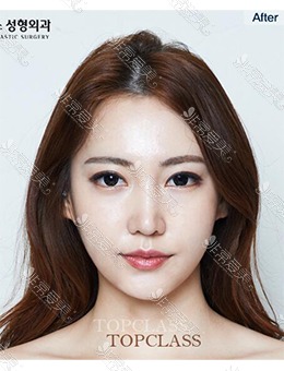 韩国Topclass整形外科做了眼鼻整形，术后风格大变样！_术后