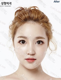 韩国Topclass整形外科眼鼻+脂肪填充，是甜美小姐姐了