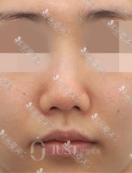 韩国JUST整形鼻修复手术前后对比照，精致秀气的鼻子太美了！_术前