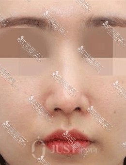 韩国JUST整形鼻修复手术前后对比照，精致秀气的鼻子太美了！_术后