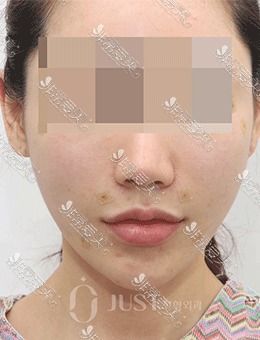 韩国JUST整形前脸颊轮廓提升日记分享，术后真的很减龄！_术后