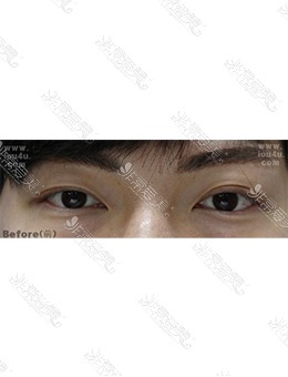 韩国IOU整形外科双眼皮变单眼皮，术后更显魅力！_术前