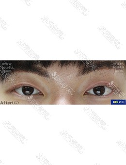 -韩国IOU整形外科双眼皮变单眼皮，术后更显魅力！
