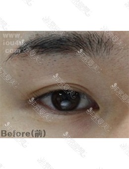 -韩国IOU整形外科双眼皮修复，眼睛自然又真实！