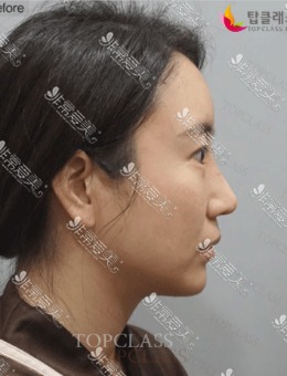-公开韩国topclass鼻子案例，果然是小翘鼻整形必选医院！