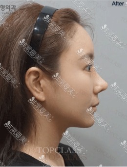 公开韩国topclass鼻子案例，果然是小翘鼻整形必选医院！_术后