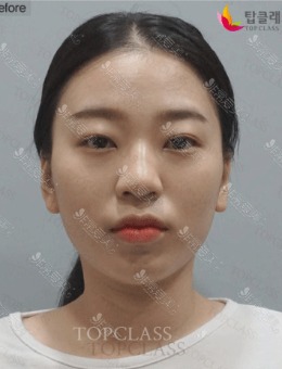 韩国Topclass整形做鼻子+面提升手术，术后年轻五岁左右！_术前