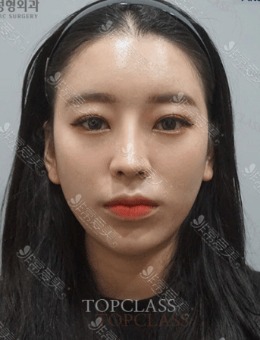 -韩国Topclass整形做鼻子+面提升手术，术后年轻五岁左右！