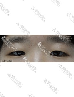 韩国IOU整形医院切开双眼皮+眼睑下垂修复术后13天照片分享！_术前