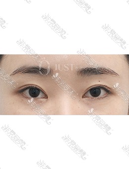 在韩国JUST整形做了眼皮细微脂肪移植术，真的年轻了很多!_术后