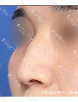 -韩国WAVE整形外科男士鼻整形，术后立体感十足！