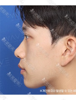 韩国WAVE整形外科驼峰鼻矫正，鼻型大翻身~_术前