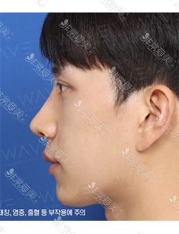 韩国WAVE整形外科驼峰鼻矫正，鼻型大翻身~