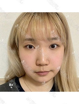 韩国ICON整形外科眼部整形，术后任何表情下都是美的！_术前