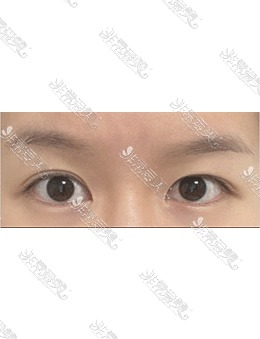 韩国icon医院埋线眼修复术前术后对比，术后眼睛太美了!_术前