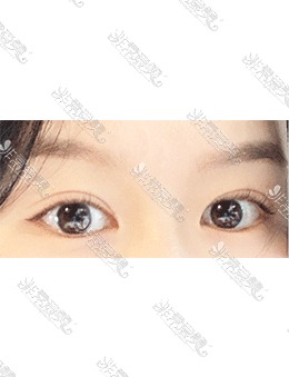 -韩国icon医院埋线眼修复术前术后对比，术后眼睛太美了!