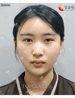 韩国TopClass整形外科隆鼻+面部填充，改变何止一点点！_术前