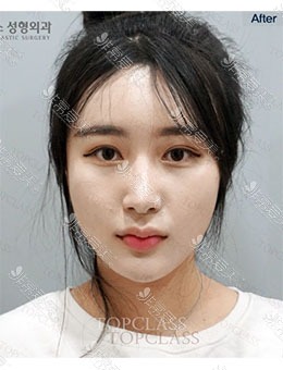 -韩国TopClass整形外科隆鼻+面部填充，改变何止一点点！