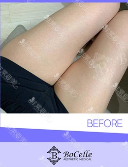 -韩国宝士丽大腿吸脂术前、术后穿塑身裤的对比图片公开，疗效喜人~