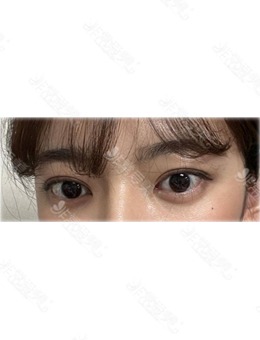 在韩国欧艾尔ONAIR整形外科做眼型矫正和双眼皮之后眼睛大了一倍！_术后