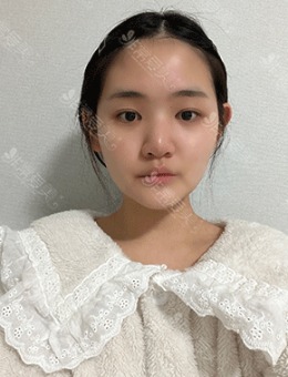韩国ucanb整形医院做假体隆鼻，术后1个月朋友说我整个人风格都变了！
