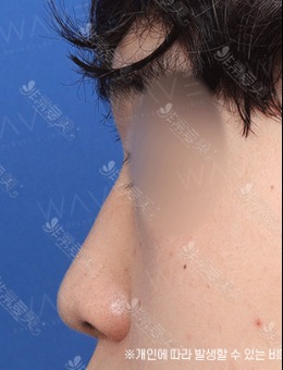 -男士鼻整形对比图，术后很帅气强烈推荐韩国WAVE整形医院！