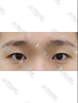 韩国AND医院自然粘连双眼皮+开眼角术前术后对比照分享！