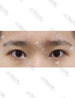 韩国AND医院自然粘连双眼皮+开眼角术前术后对比照分享！