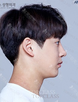 韩国TopClass整形外科医院男士鼻子整形前后照片分享~