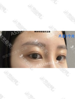 分享韩国德丽珍整形提肌+非切开双眼皮手术对比照，1个月就恢复的如此好！_术后