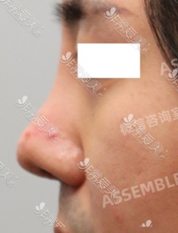 韩国德丽珍整形医院男士鼻修复术前术后3个月图曝光！_术前