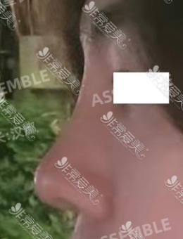 韩国德丽珍整形医院男士鼻修复术前术后3个月图曝光！