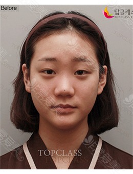 韩国topclass鼻子案例公开,有名的隆鼻医生做鼻子就是好看!_术前