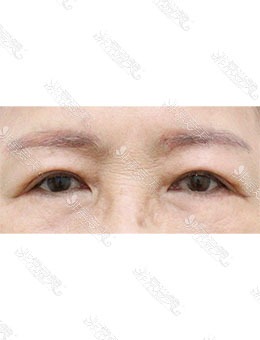 韩国AND整形外科眼部综合整形，眼周年轻化肉眼可见！
