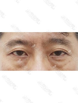 韩国AND整形外科男士眼袋手术，比同龄人年轻十岁！