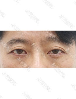 韩国AND整形外科男士眼袋手术，比同龄人年轻十岁！_术后